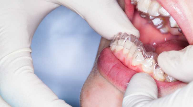 Contention en orthodontie