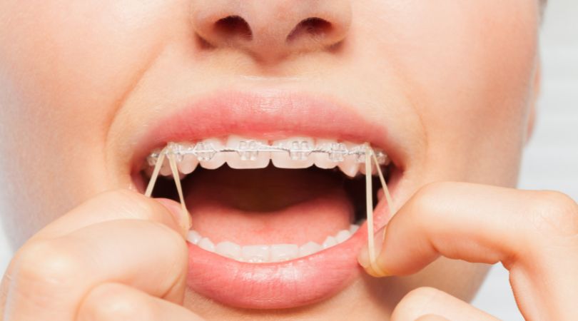 Les élastiques en orthodontie : comment fonctionnent-ils ?