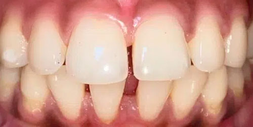 Cas-cliniques-avant-Dentiste-Fontenay