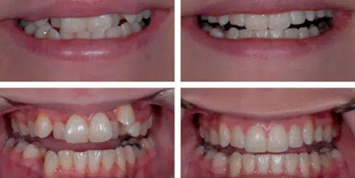 Cas-cliniques-avant-et-apres-Dentiste-Fontenay
