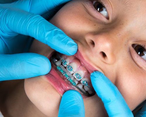 enfant-orthodontiste